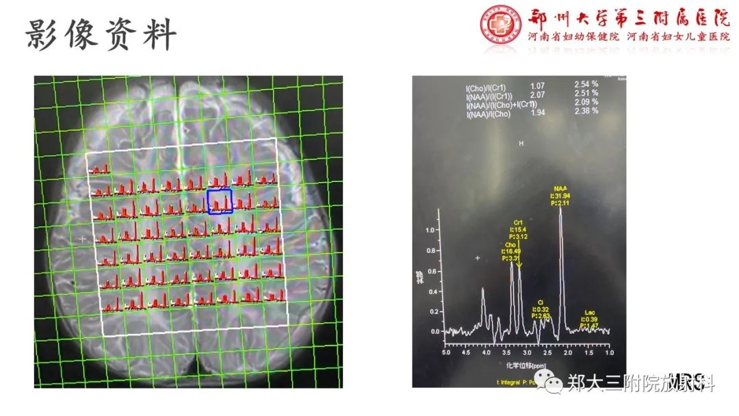 【PPT】佩梅病的影像诊断-7