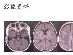 佩梅病的影像诊断