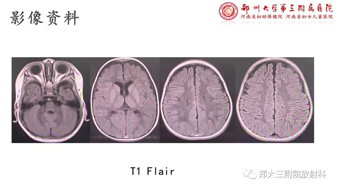 【PPT】佩梅病的影像诊断-4