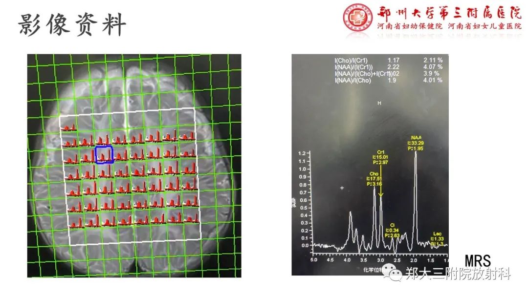 【PPT】佩梅病的影像诊断-6