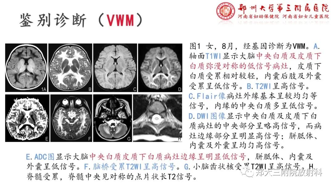 【PPT】佩梅病的影像诊断-14