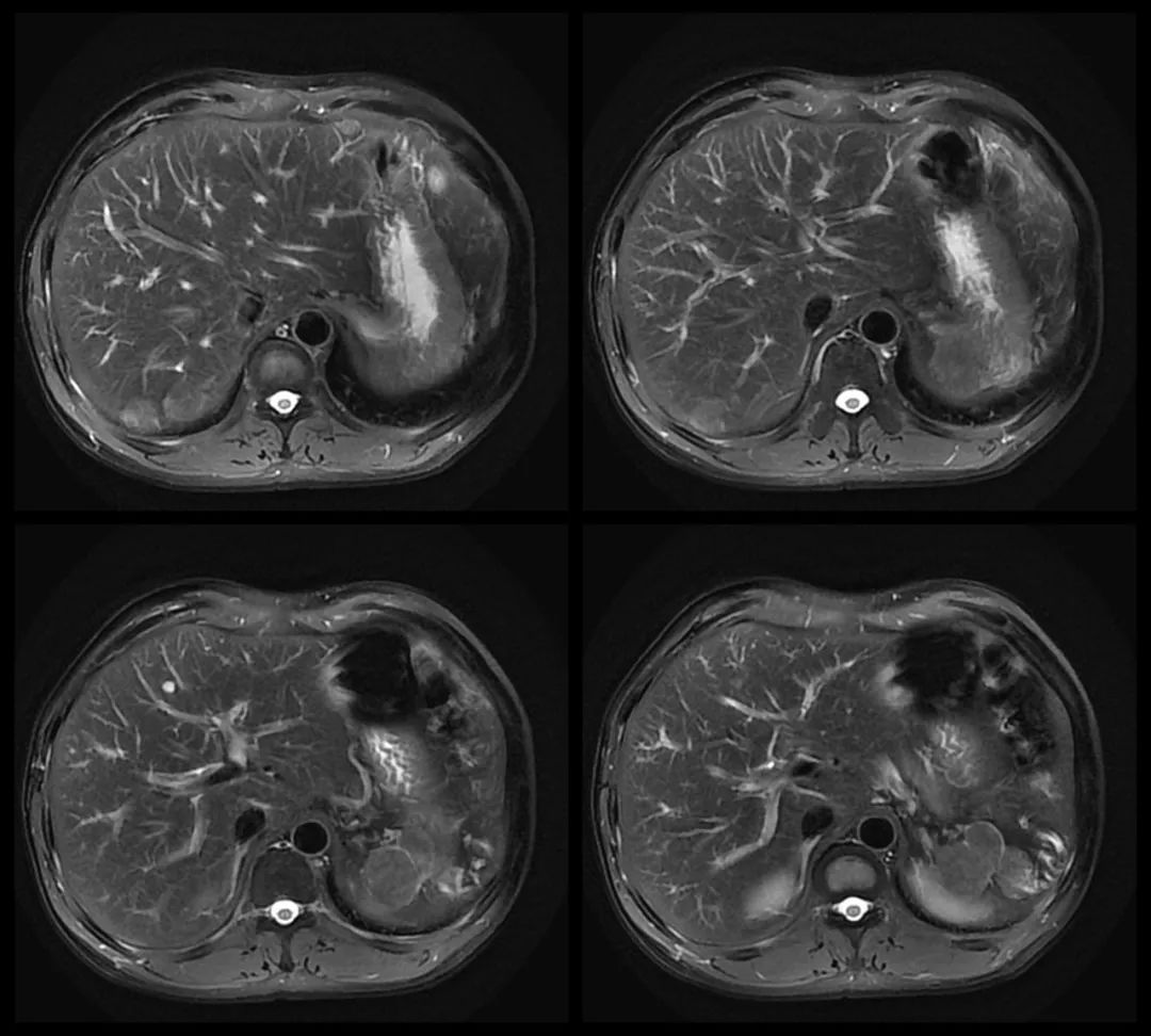 【病例】腹腔异位脾种植1例CT及MR影像-5
