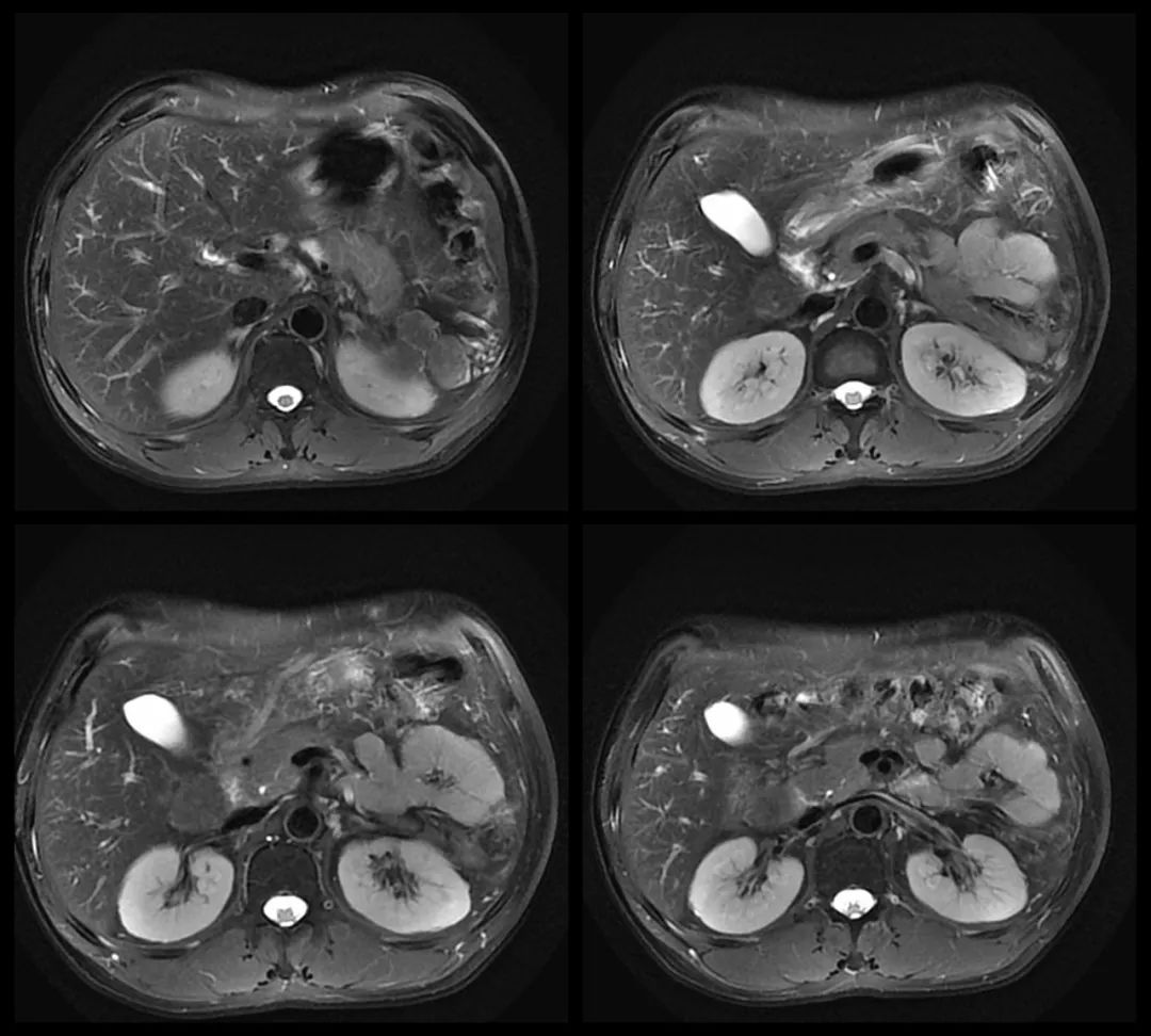 【病例】腹腔异位脾种植1例CT及MR影像-6