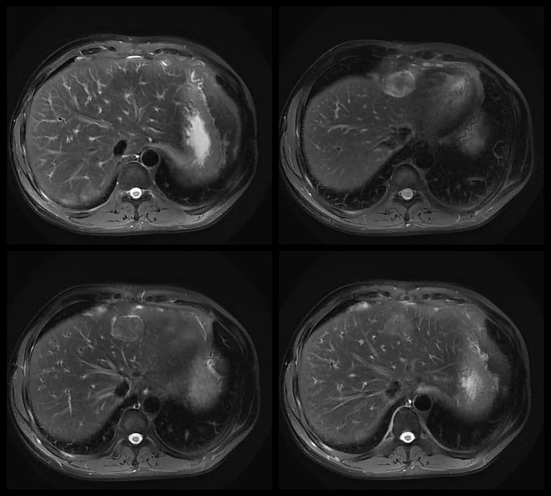 【病例】腹腔异位脾种植1例CT及MR影像-4