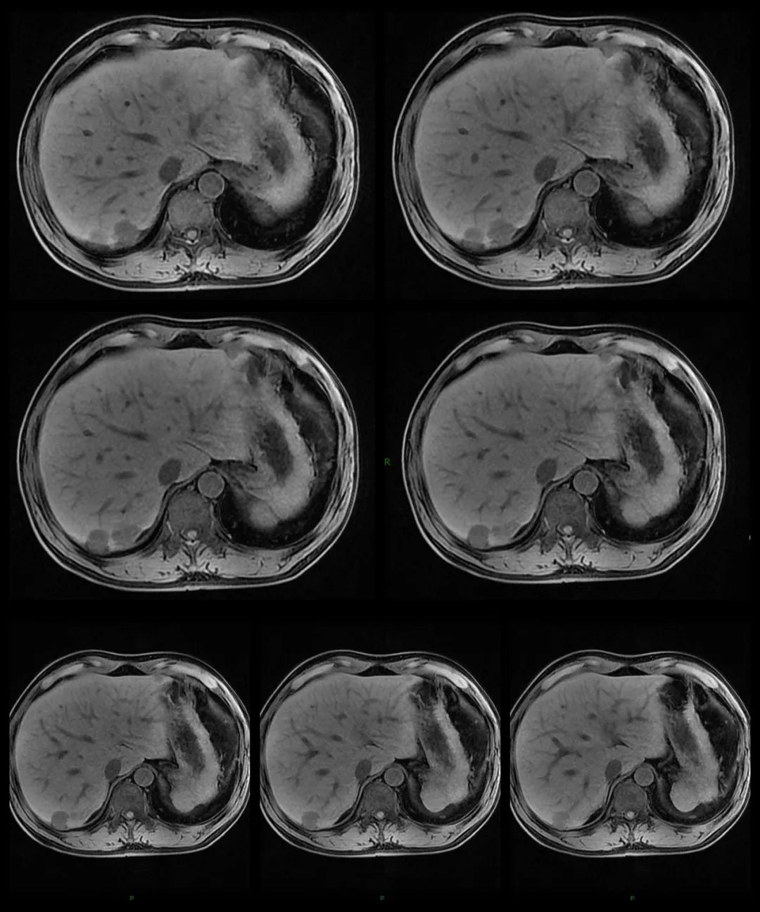 【病例】腹腔异位脾种植1例CT及MR影像-7