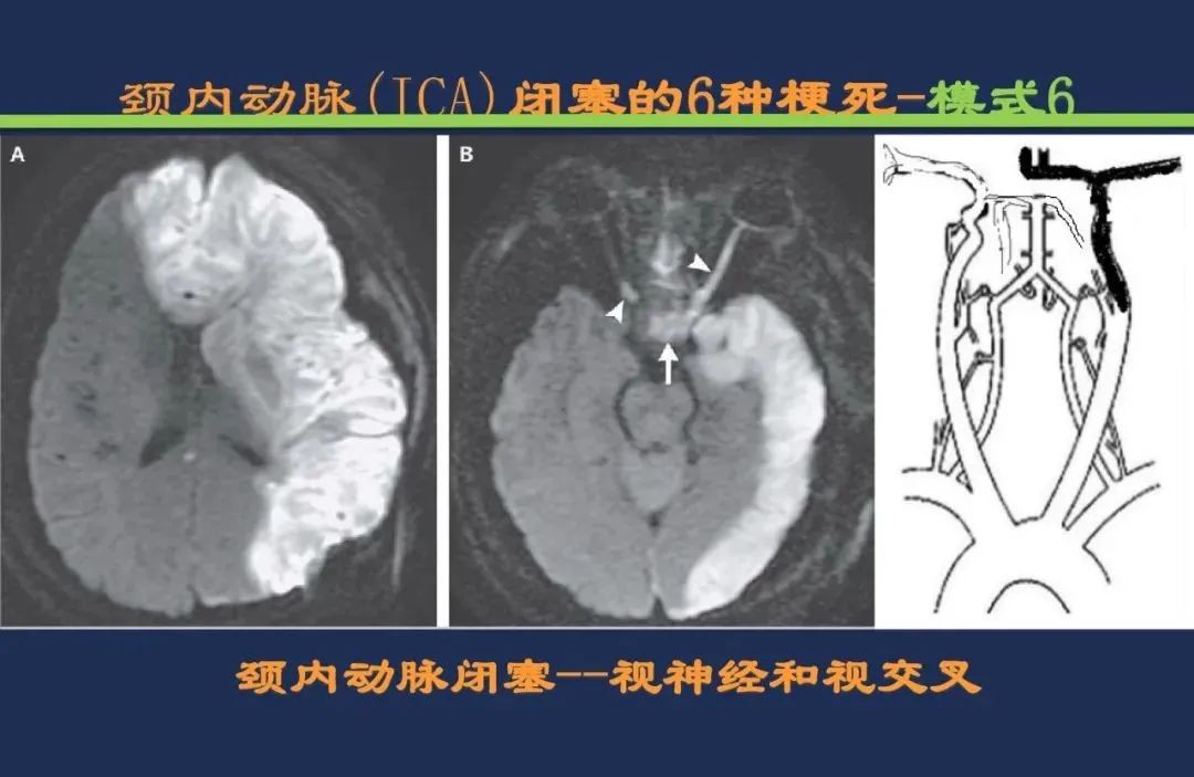 从梗死部位推测责任血管：脑血管解剖-20