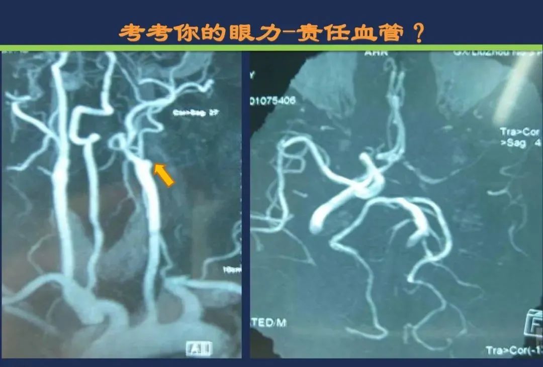 从梗死部位推测责任血管：脑血管解剖-28
