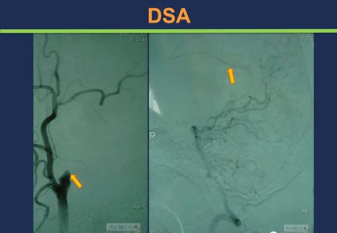从梗死部位推测责任血管：脑血管解剖-25
