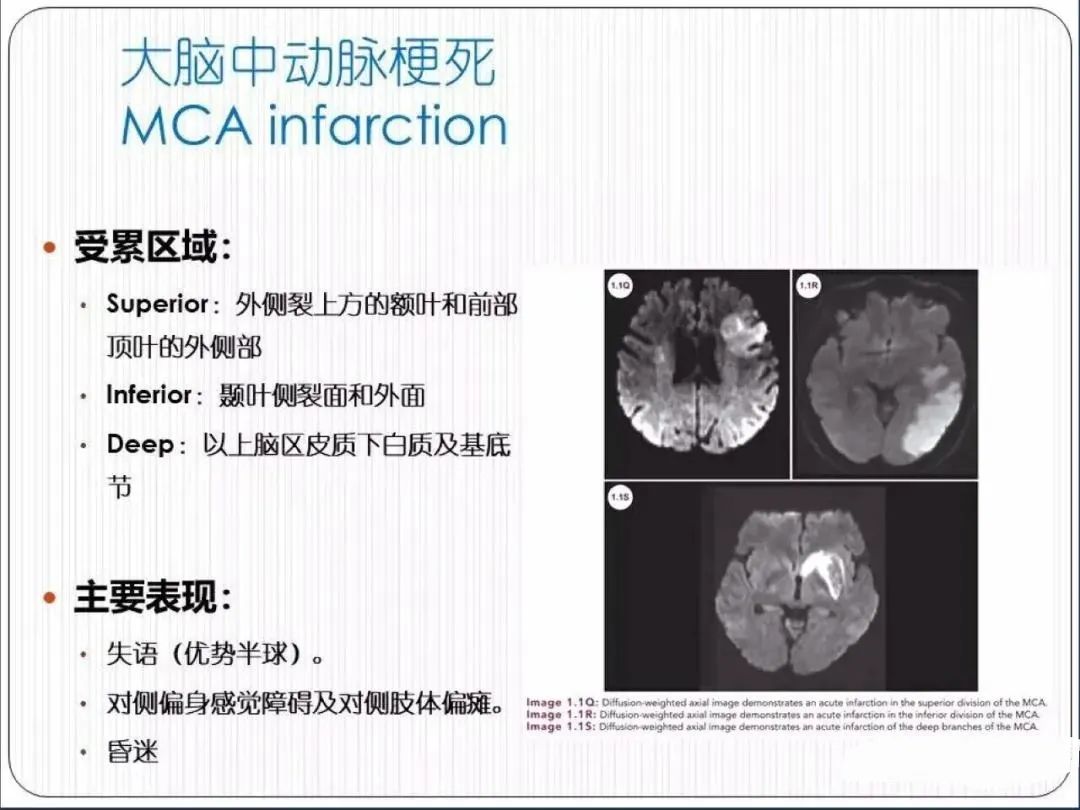 从梗死部位推测责任血管：脑血管解剖-36