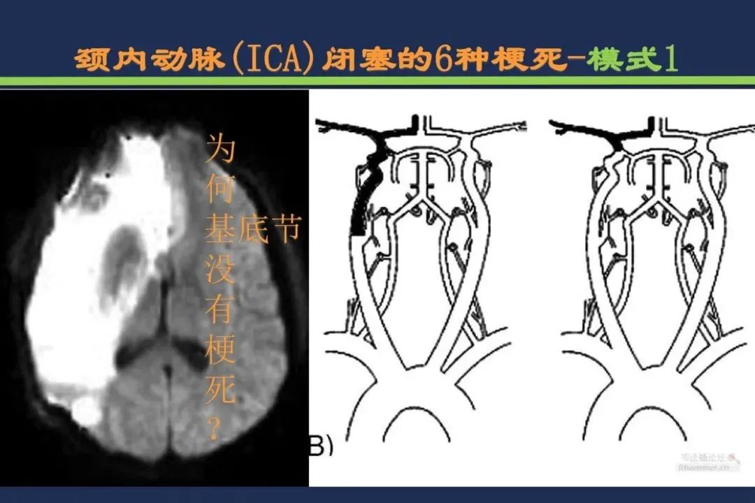 从梗死部位推测责任血管：脑血管解剖-15