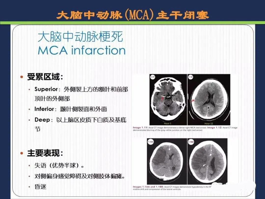 从梗死部位推测责任血管：脑血管解剖-39