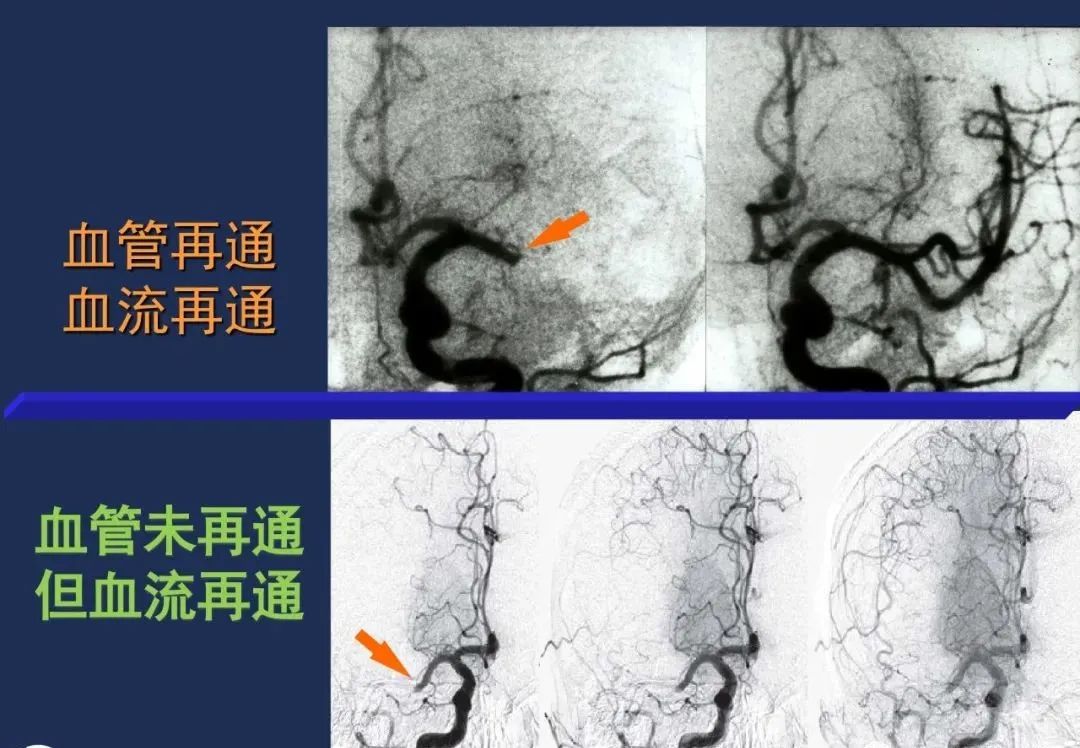 从梗死部位推测责任血管：脑血管解剖-29