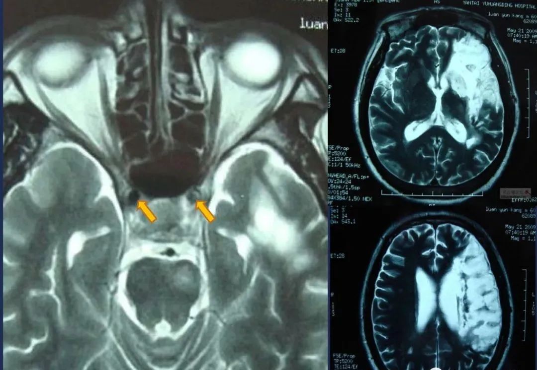 从梗死部位推测责任血管：脑血管解剖-24