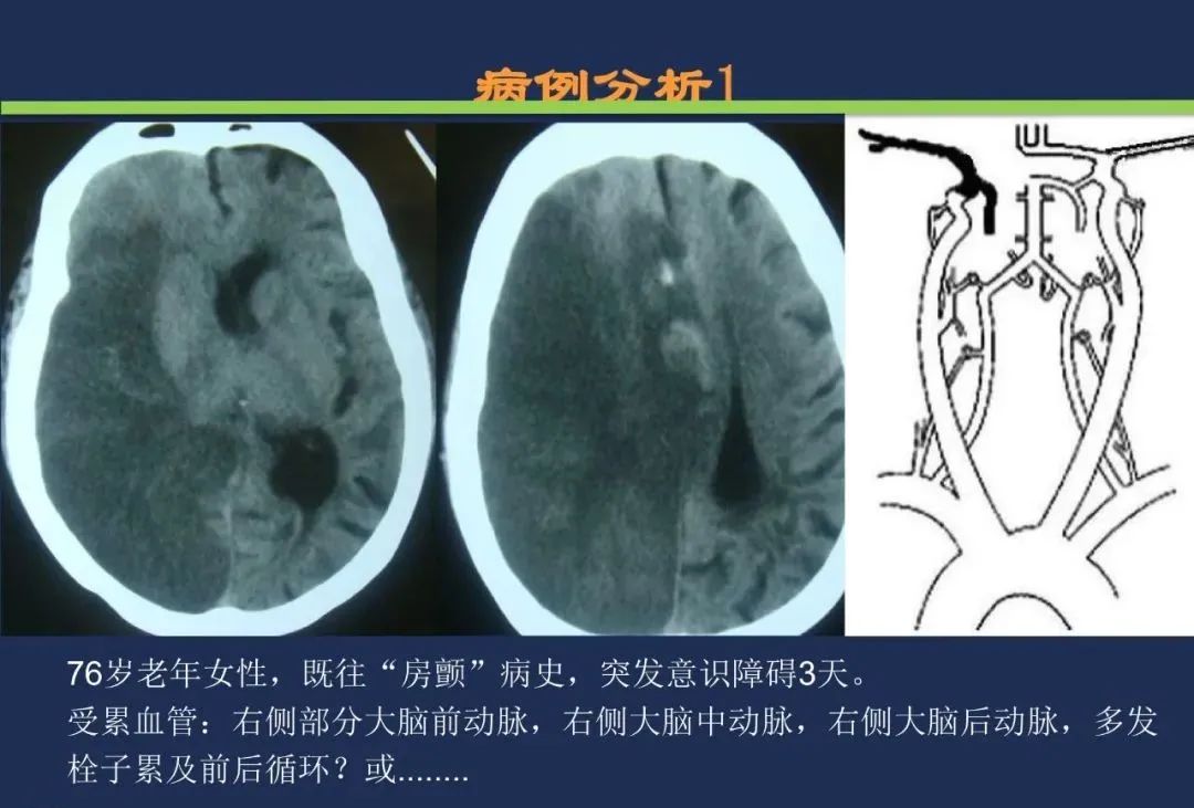 从梗死部位推测责任血管：脑血管解剖-21