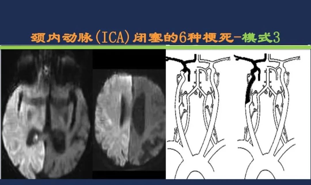 从梗死部位推测责任血管：脑血管解剖-17