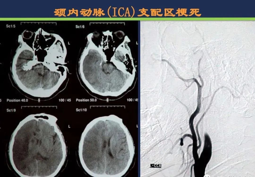 从梗死部位推测责任血管：脑血管解剖-14