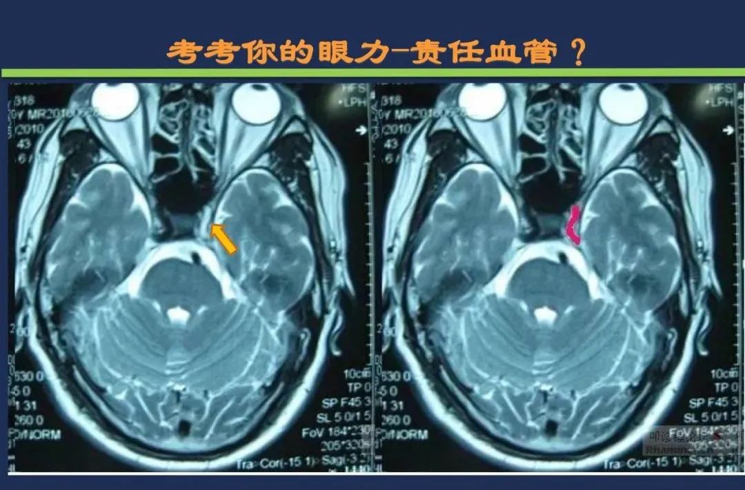 从梗死部位推测责任血管：脑血管解剖-27