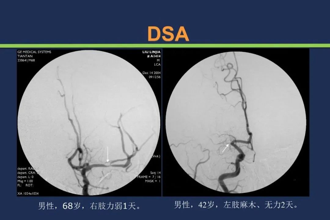 从梗死部位推测责任血管：脑血管解剖-37