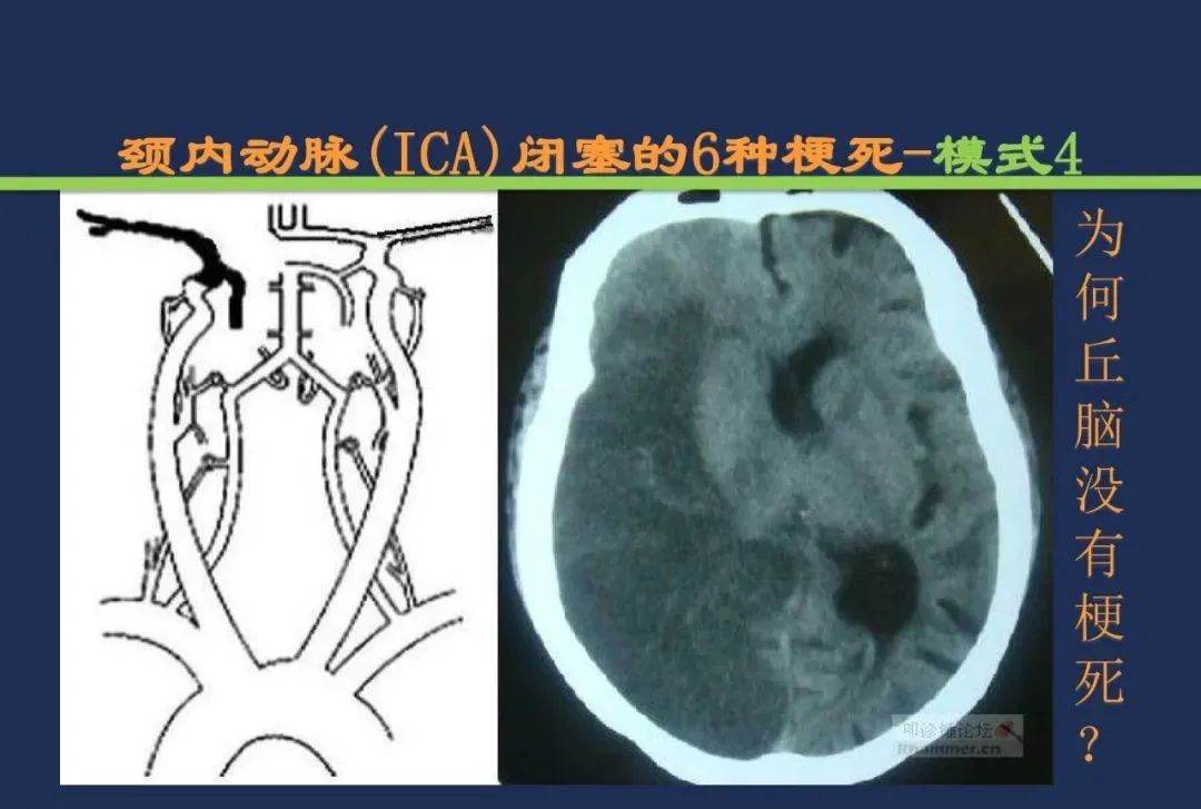 从梗死部位推测责任血管：脑血管解剖-18