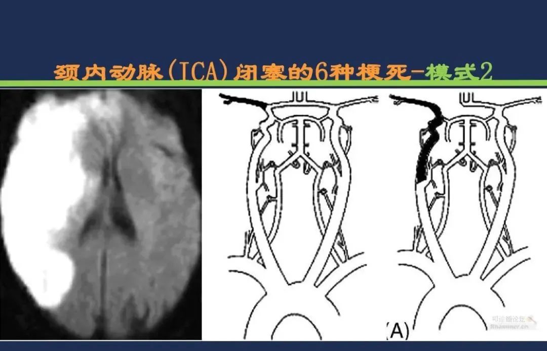 从梗死部位推测责任血管：脑血管解剖-16