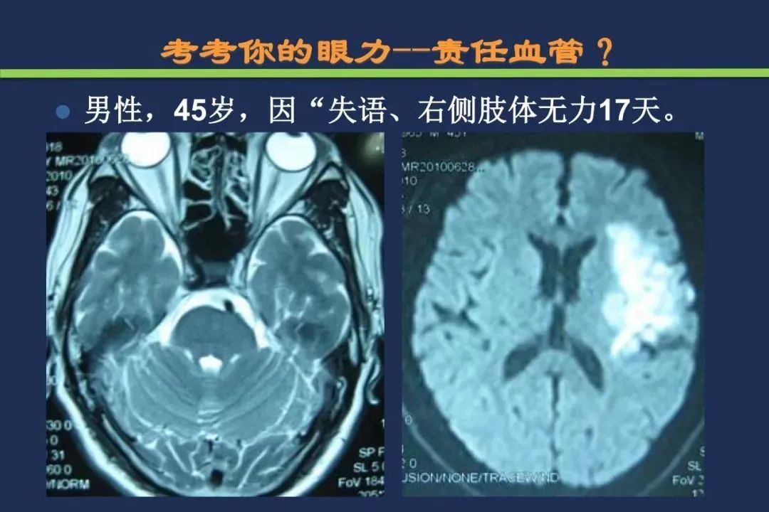 从梗死部位推测责任血管：脑血管解剖-26