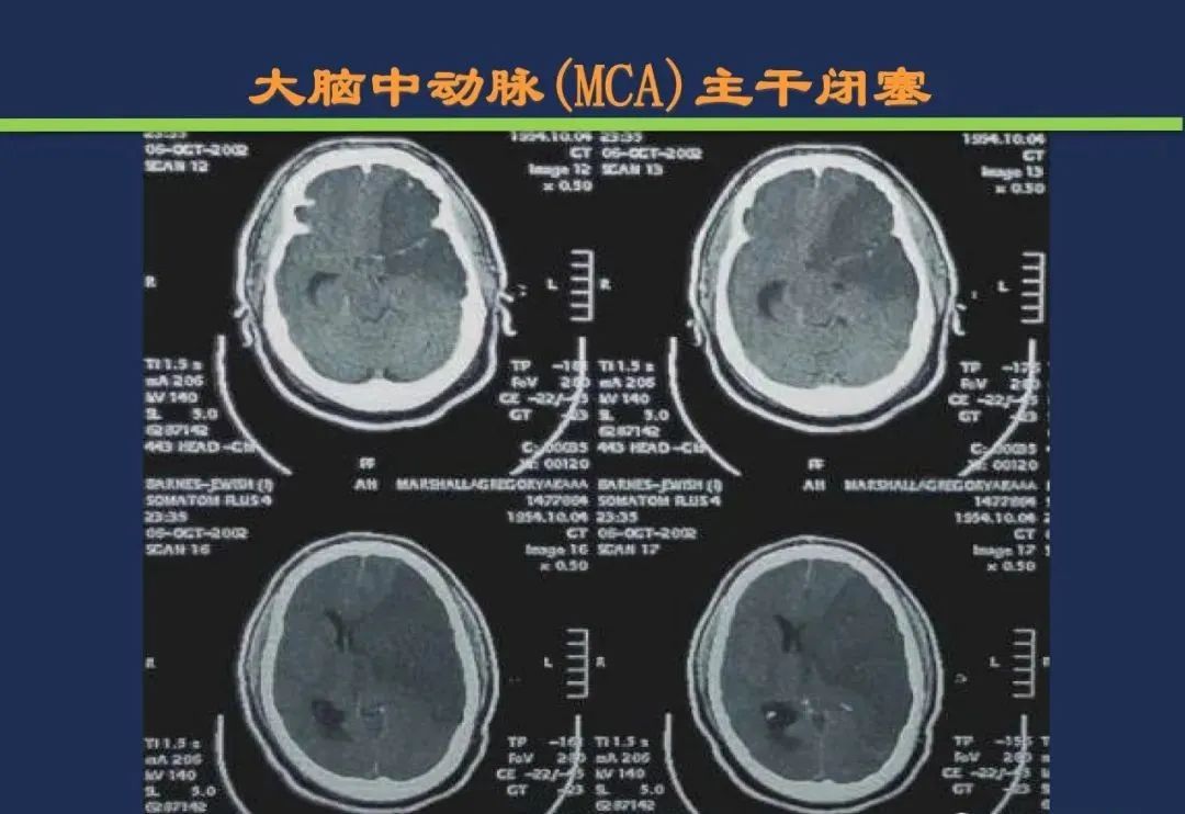 从梗死部位推测责任血管：脑血管解剖-38