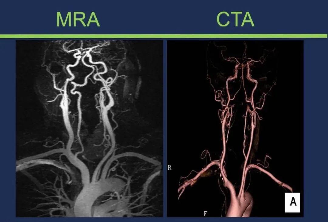从梗死部位推测责任血管：脑血管解剖-5