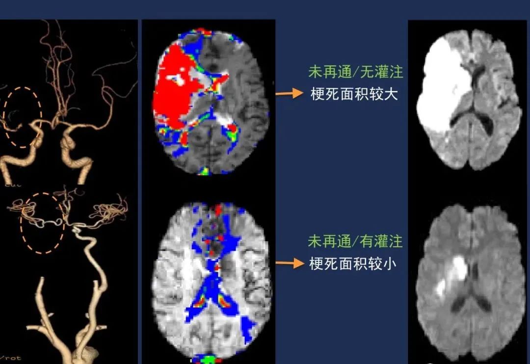 从梗死部位推测责任血管：脑血管解剖-30