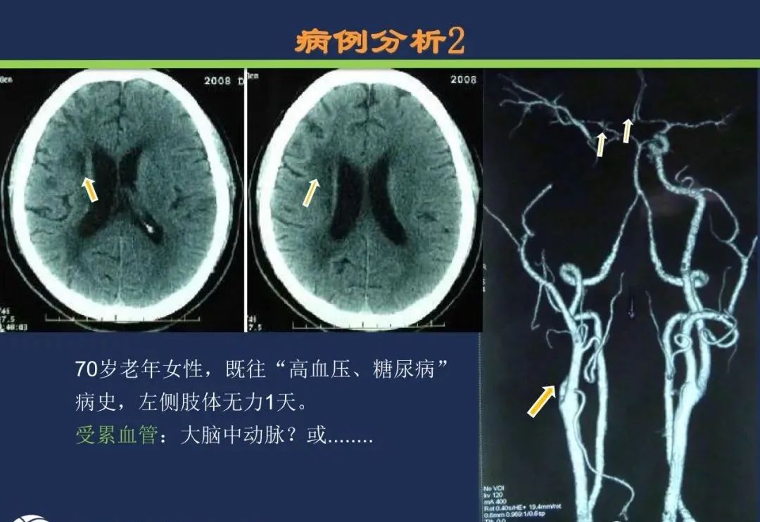 从梗死部位推测责任血管：脑血管解剖-22