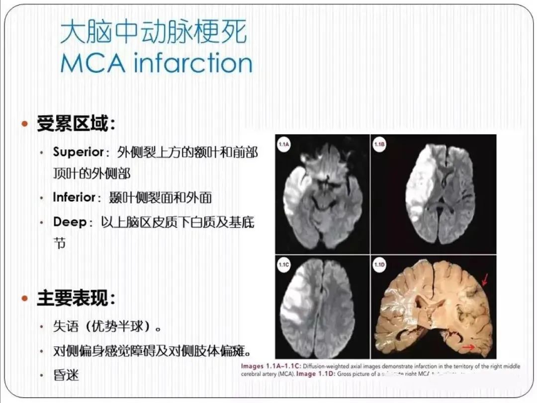 从梗死部位推测责任血管：脑血管解剖-35