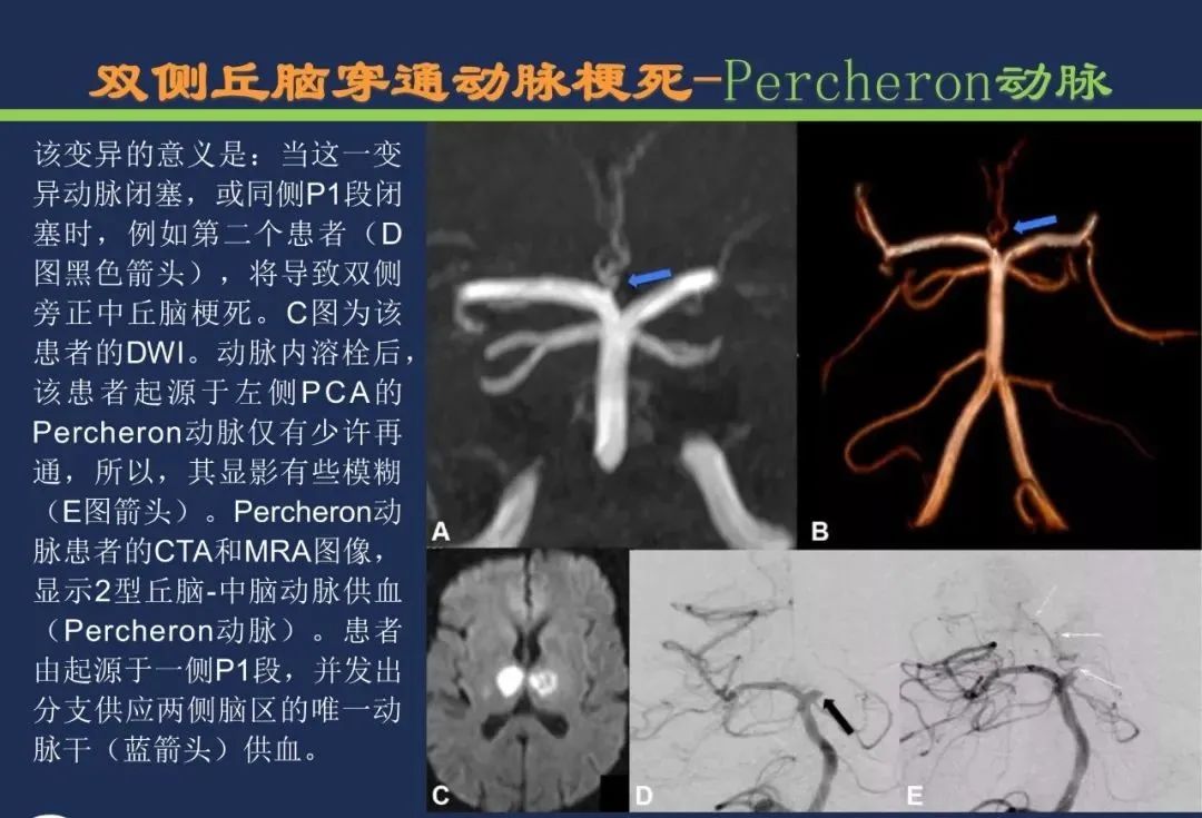 从梗死部位推测责任血管：脑血管解剖-107