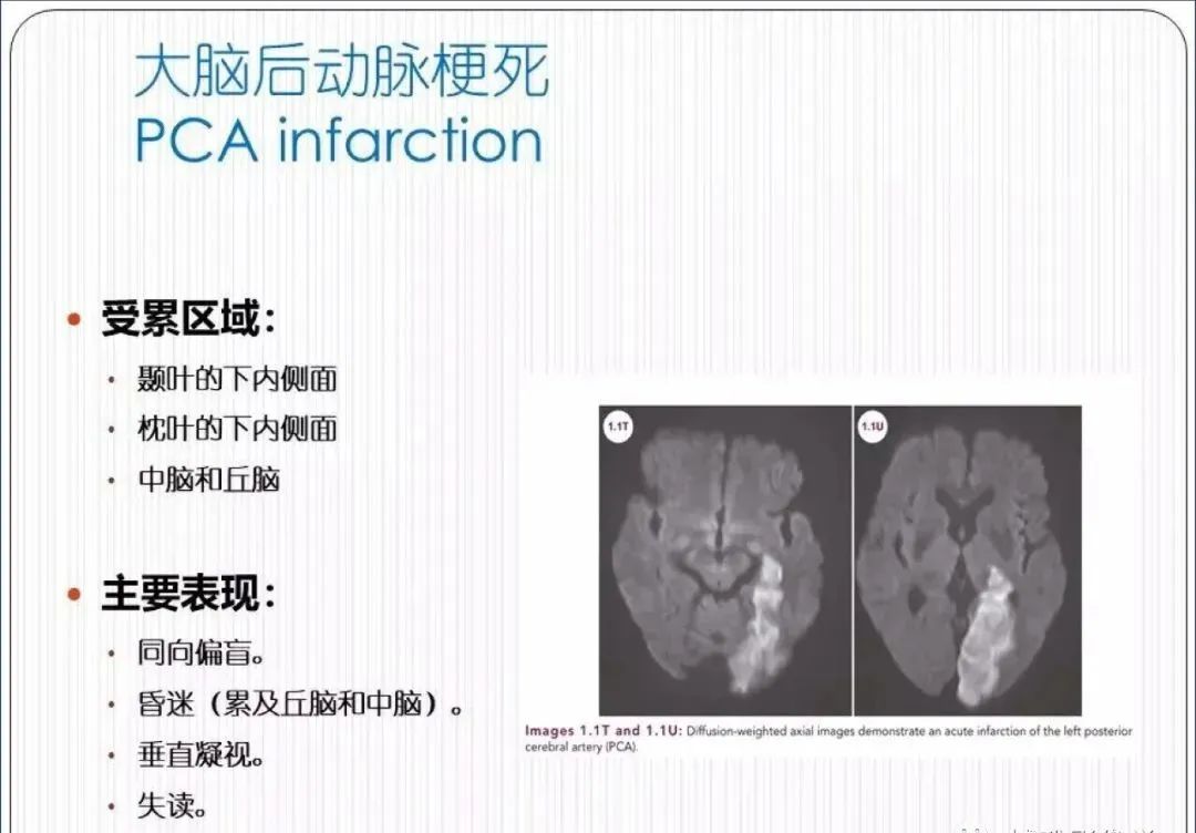 从梗死部位推测责任血管：脑血管解剖-90