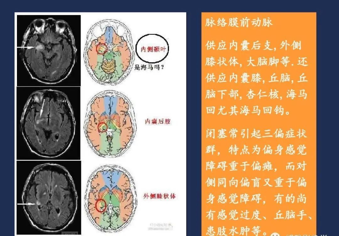 从梗死部位推测责任血管：脑血管解剖-80