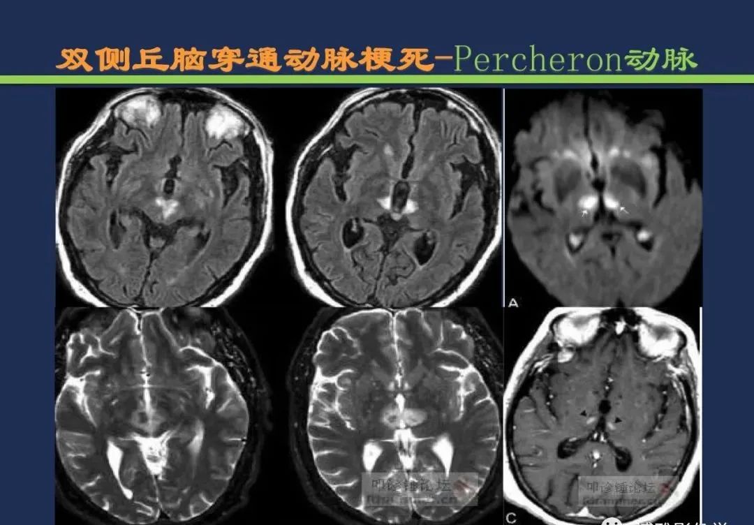 从梗死部位推测责任血管：脑血管解剖-109