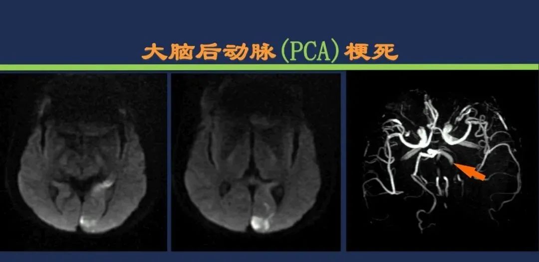 从梗死部位推测责任血管：脑血管解剖-92