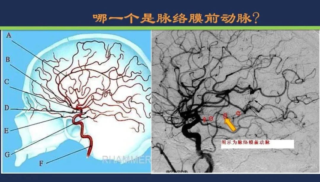 从梗死部位推测责任血管：脑血管解剖-76