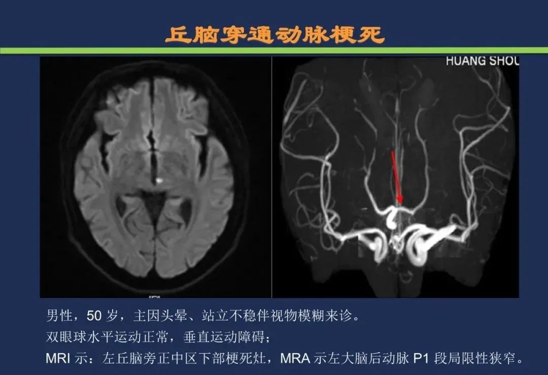 从梗死部位推测责任血管：脑血管解剖-101