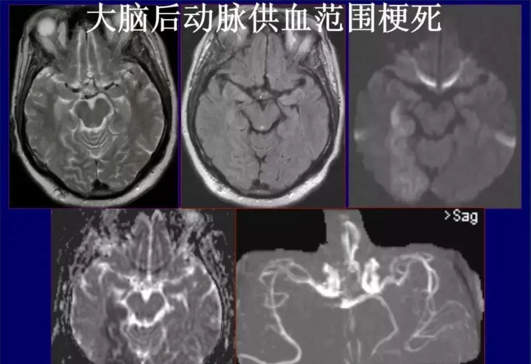 从梗死部位推测责任血管：脑血管解剖-95