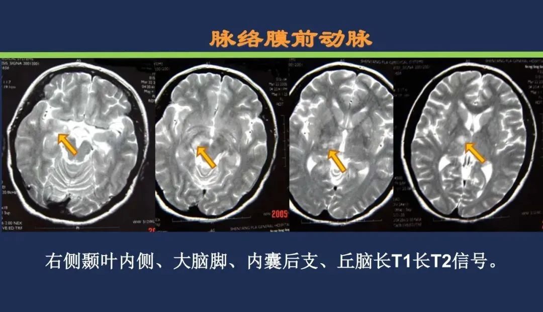 从梗死部位推测责任血管：脑血管解剖-81