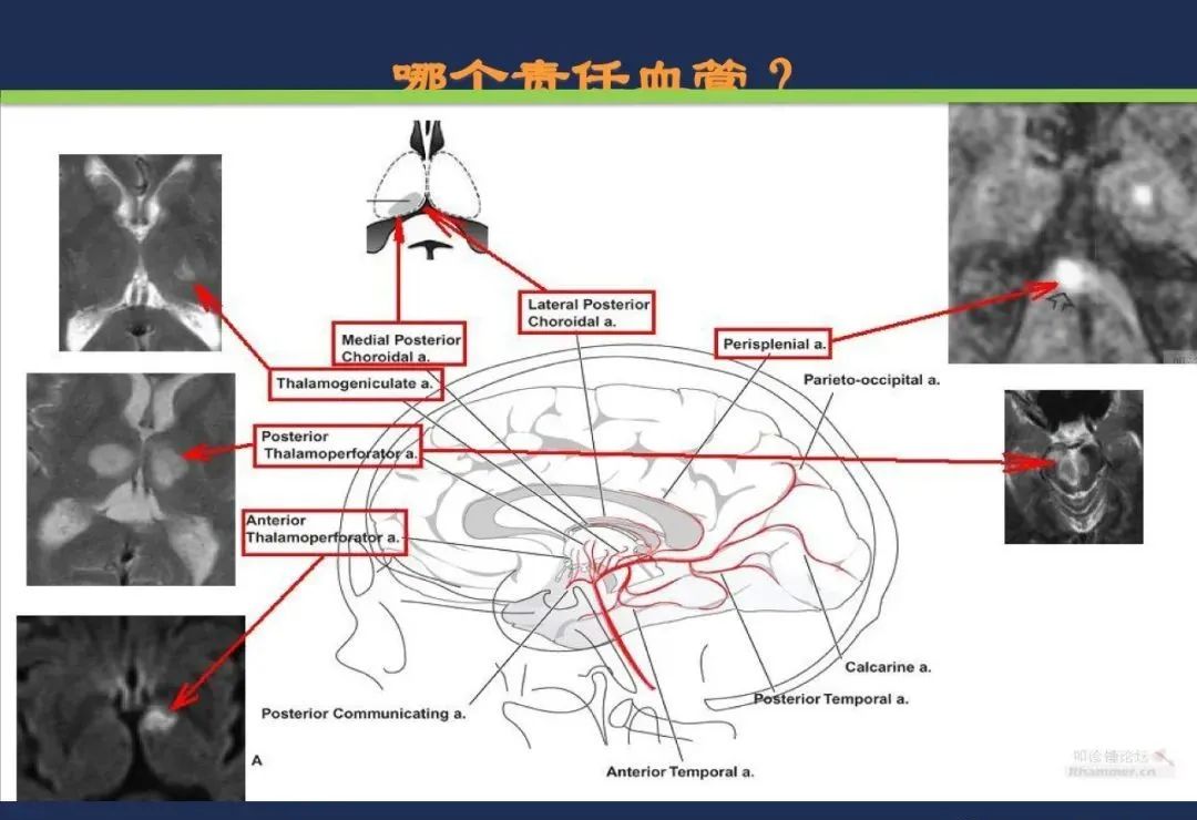 从梗死部位推测责任血管：脑血管解剖-89