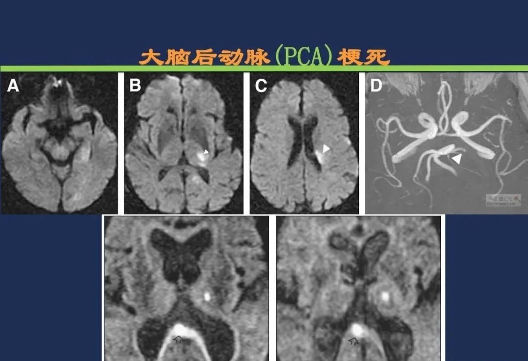 从梗死部位推测责任血管：脑血管解剖-94