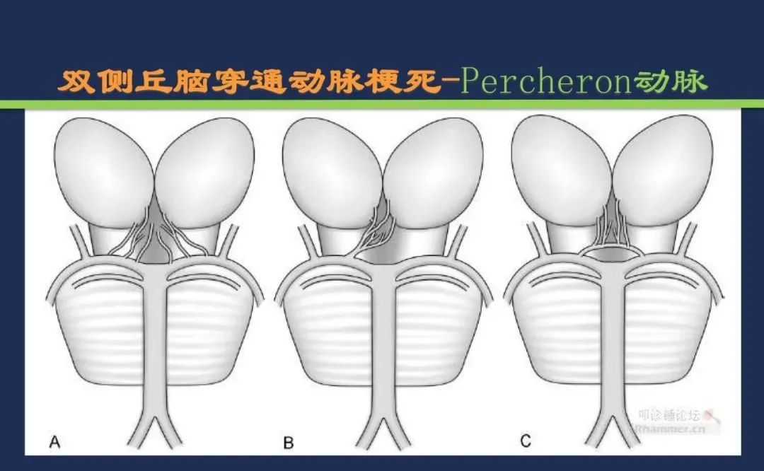 从梗死部位推测责任血管：脑血管解剖-106