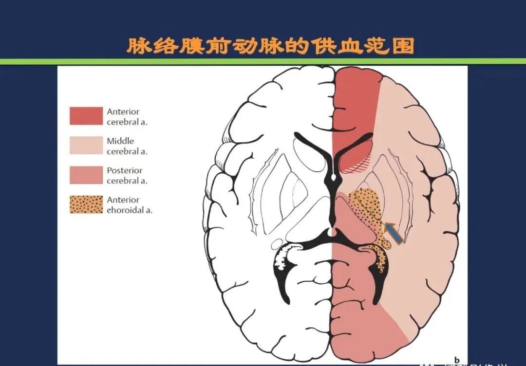 从梗死部位推测责任血管：脑血管解剖-78