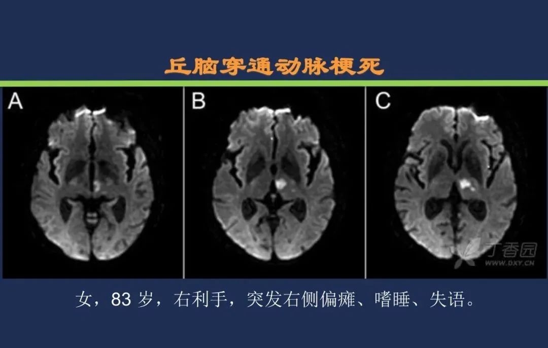 从梗死部位推测责任血管：脑血管解剖-102