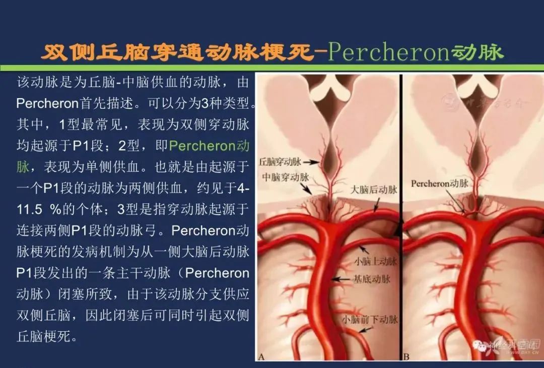 从梗死部位推测责任血管：脑血管解剖-105