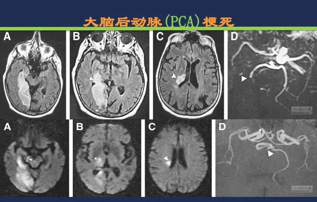 从梗死部位推测责任血管：脑血管解剖-93