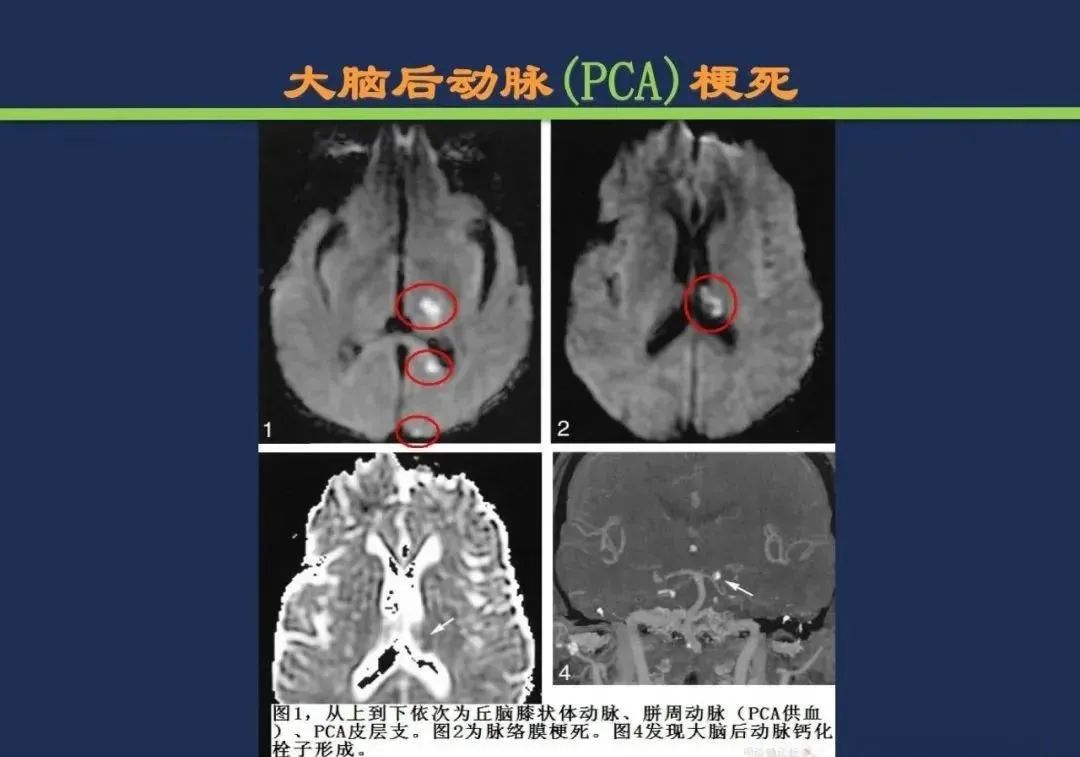 从梗死部位推测责任血管：脑血管解剖-91