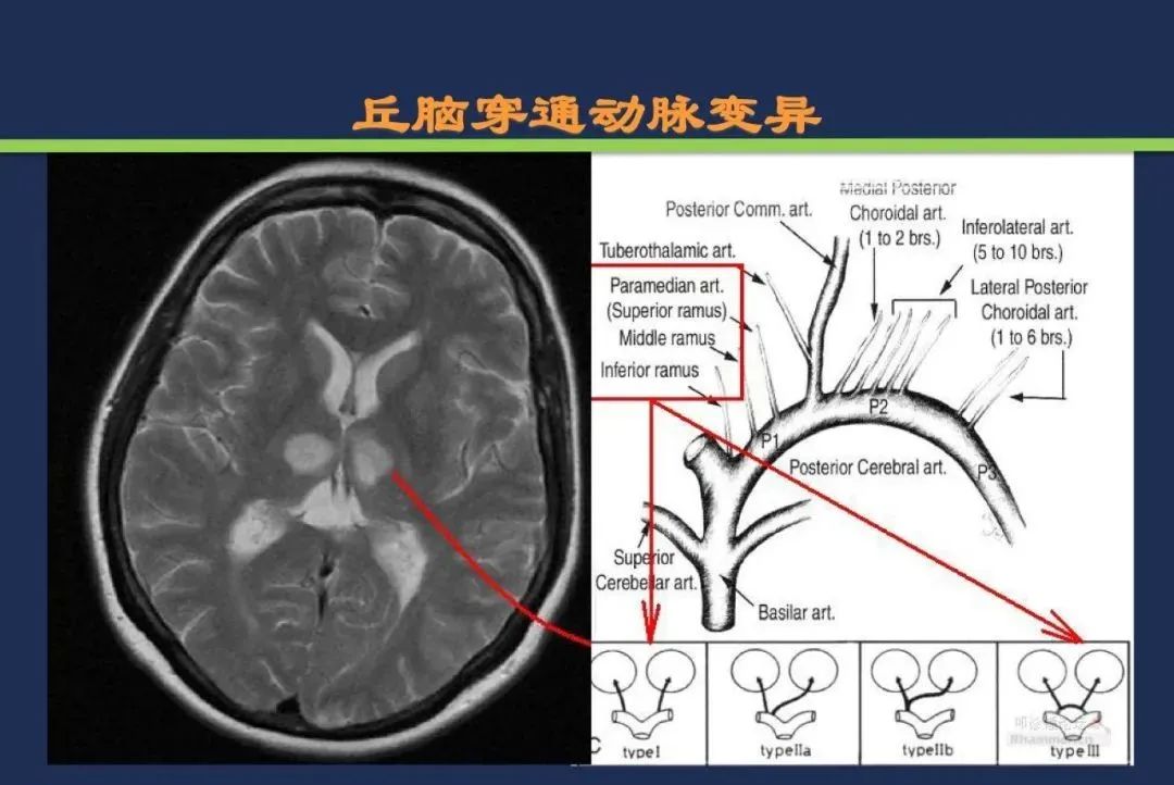 从梗死部位推测责任血管：脑血管解剖-104