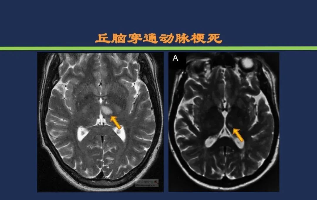 从梗死部位推测责任血管：脑血管解剖-103