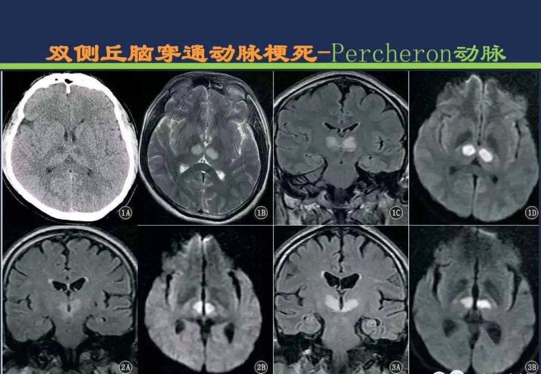 从梗死部位推测责任血管：脑血管解剖-108